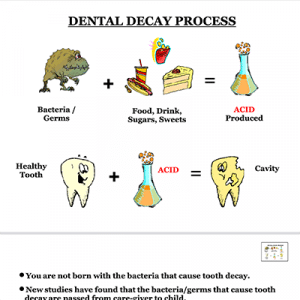 Dental Decay Process - Infographic